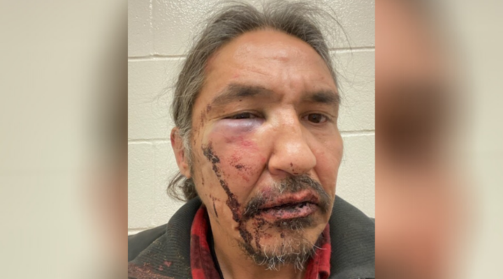 Chief Allan Adam of Athabasca Chipewyan First Nation is pictured here with a swollen eye and bloody face from a mouth laceration, after his encounter with RCMP in Fort McMurray, Alta. on March 10, 2020.