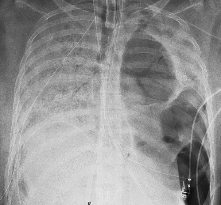 This X-ray image provided by Northwestern Medicine shows the chest of a COVID-19 patient before she received a new set of lungs.