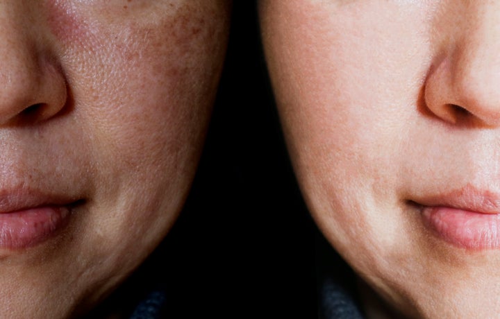 Melasma most commonly appears on the forehead, upper lip and cheeks, and women are more prone to the condition than men. The photo on the left is without makeup, and the photo on the right is with makeup.