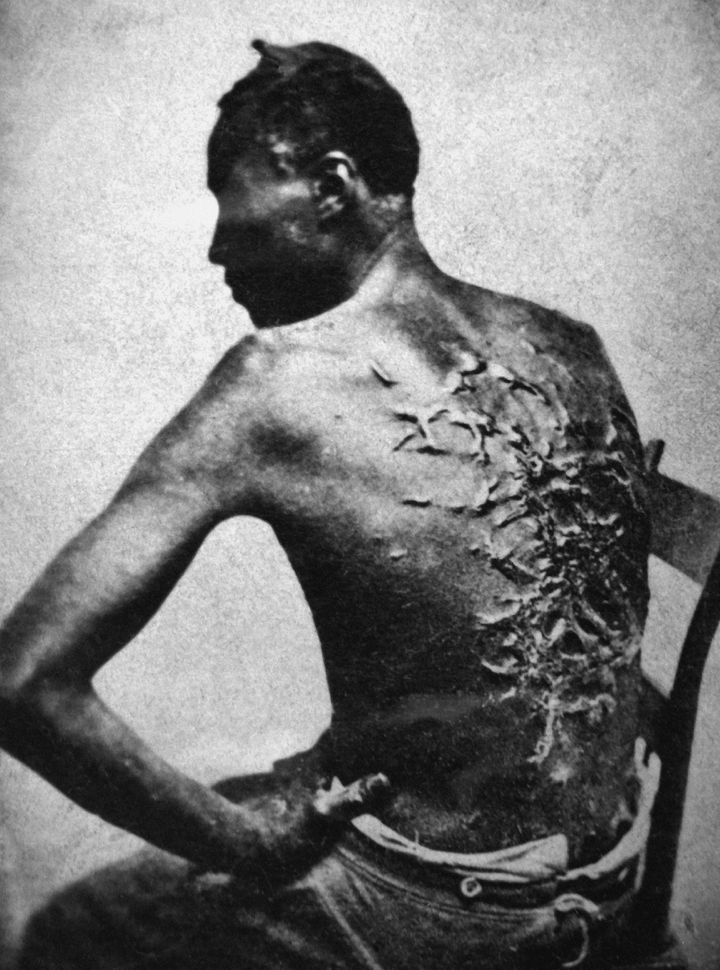 Φωτογραφία κατά τη διάρκεια ιατρικής εξέτασης στις 2 Απριλίου 1863, στο Μπατόν Ρουζ της Λουιζιάνα. Η πλάτη του Πίτερ Γκόρντον. 