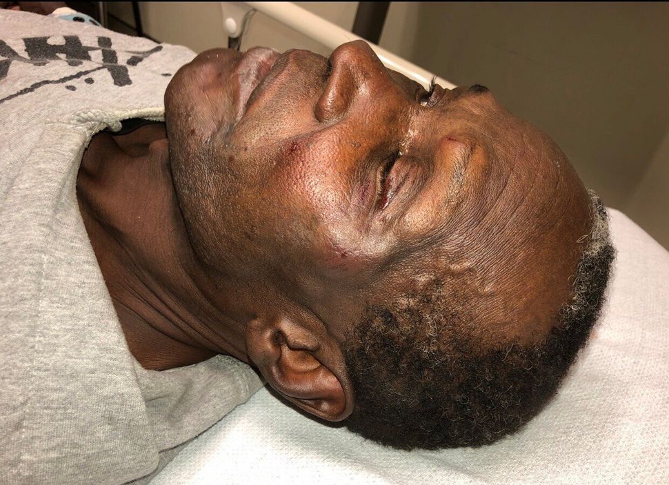 A photo of Livingston Jeffers shows bruising on his face following an altercation with police in Ajax, Ont., on Oct. 30, 2018.