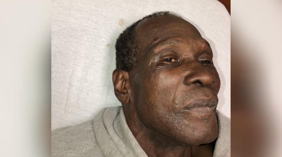 Livingston Jeffers experienced facial swelling after his violent arrest, as shown here in an Ajax, Ont. hospital, on Oct. 31, 2018.