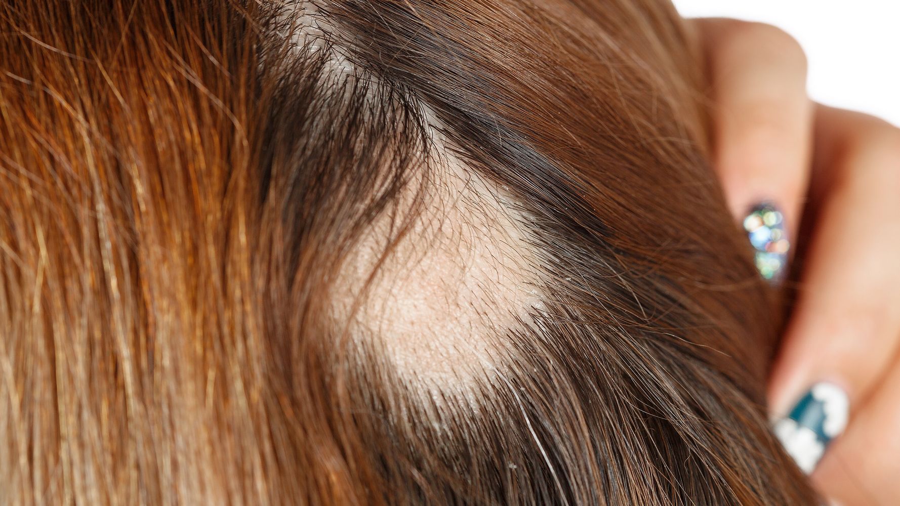 mujeres también sufren la alopecia: son los mejores tratamientos | El HuffPost Life