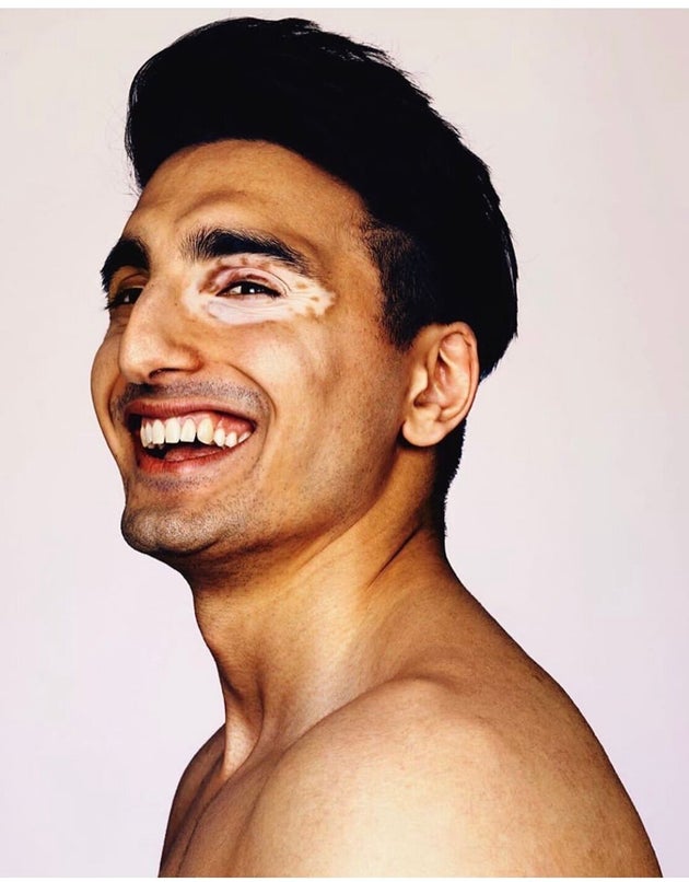 On World Vitiligo Day, 3 Young British Asians Show Their Skin Some Love