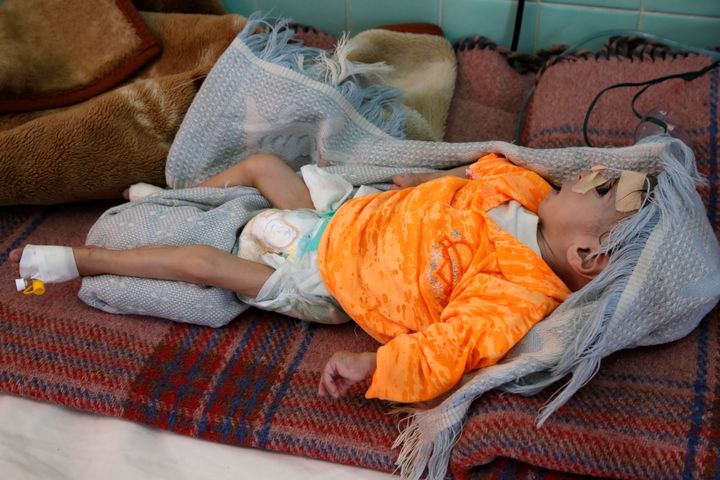 A malnourished infant at a hospital in Sanaa, Yemen, in the fall of 2019. Mass hunger in the country has reduced people's cap