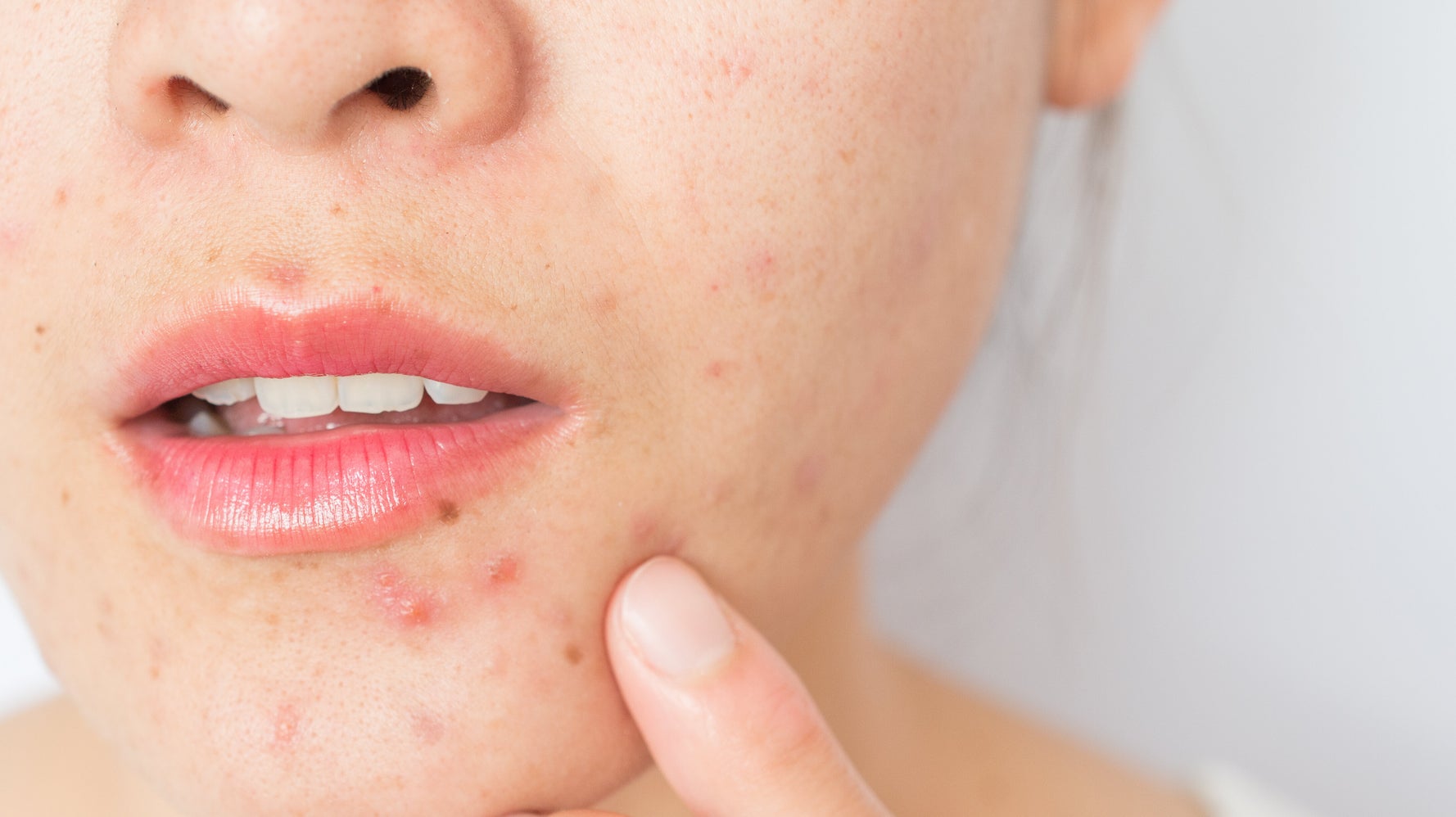 Maskné: tout ce qu'il faut savoir sur l'acné causée par le masque |  HuffPost Québec Vivre