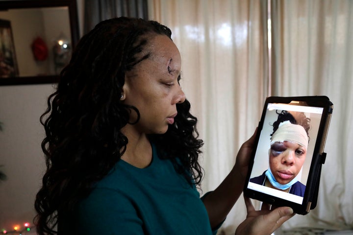 LaToya Ratlieff looks at a photograph of herself, Friday, June 12, 2020, in Lauderhill, Fla. Ratlieff was hit in the face by