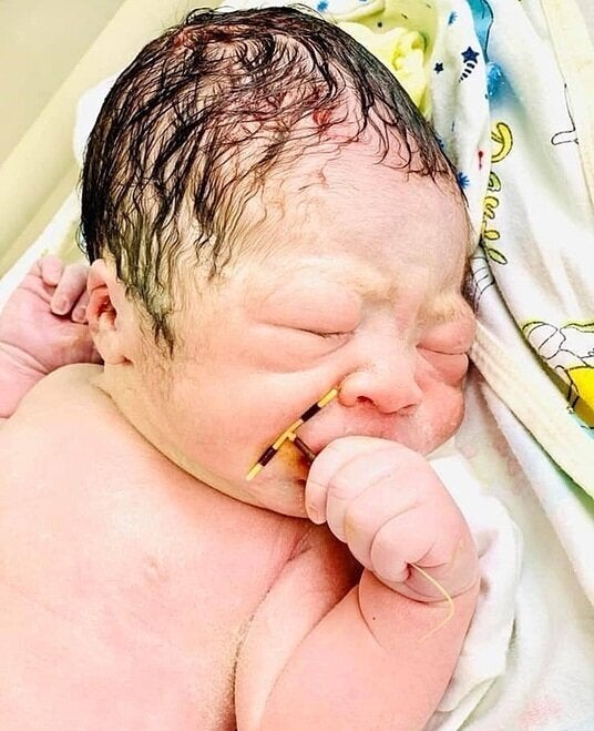 한 베트남 아기가 엄마 뱃속의 피임기구와 함께 태어났다 허프포스트코리아