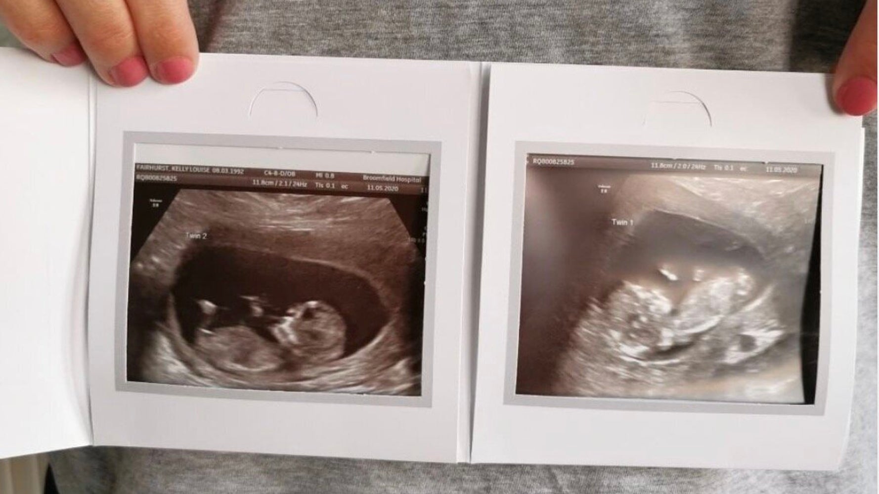 2つの子宮を持つ女性 双子をそれぞれの子宮で妊娠する 5000万分の1の可能性 と医師は驚き ハフポスト 2つの子宮を持つ女性 双子をそれぞれの子宮で妊娠する 5000万分の1の可能性 と医師は驚き ハフポスト