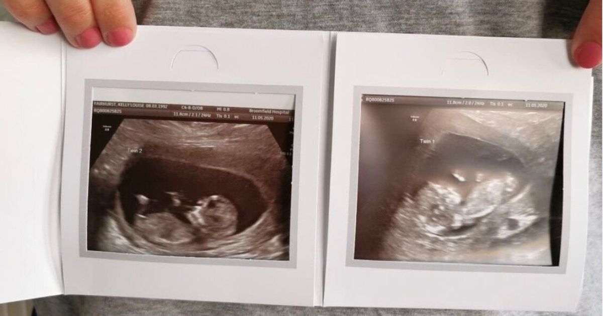 2つの子宮を持つ女性 双子をそれぞれの子宮で妊娠する 5000万分の1の可能性 と医師は驚き ハフポスト