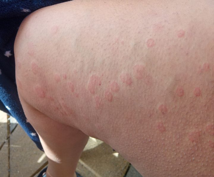 An example of urticaria in a Covid-19 patient.