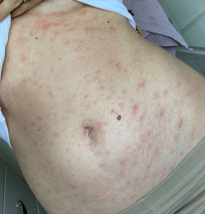 A chickenpox-type rash on the abdomen of a Covid patient.