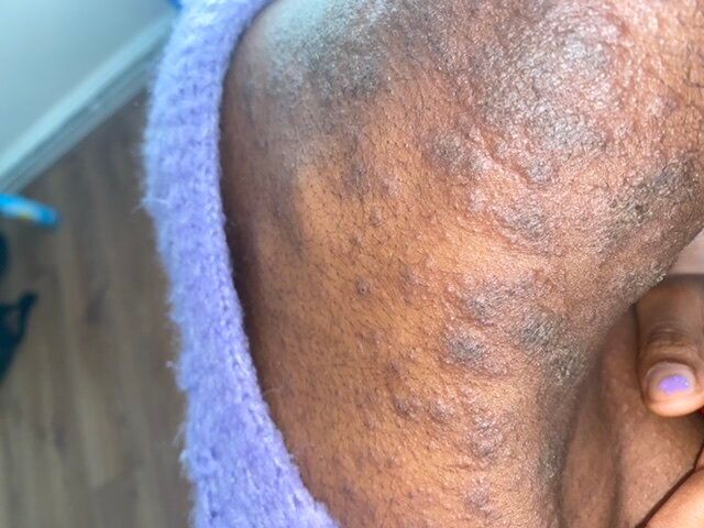 A rash on the arm of a Covid patient.