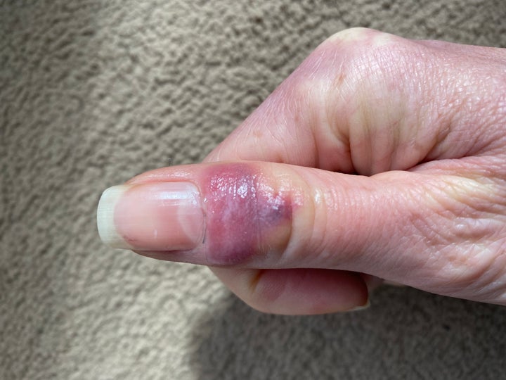 Red Rash On Thumb