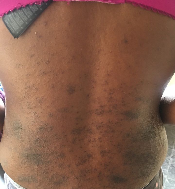 A rash on the back of a Covid patient.
