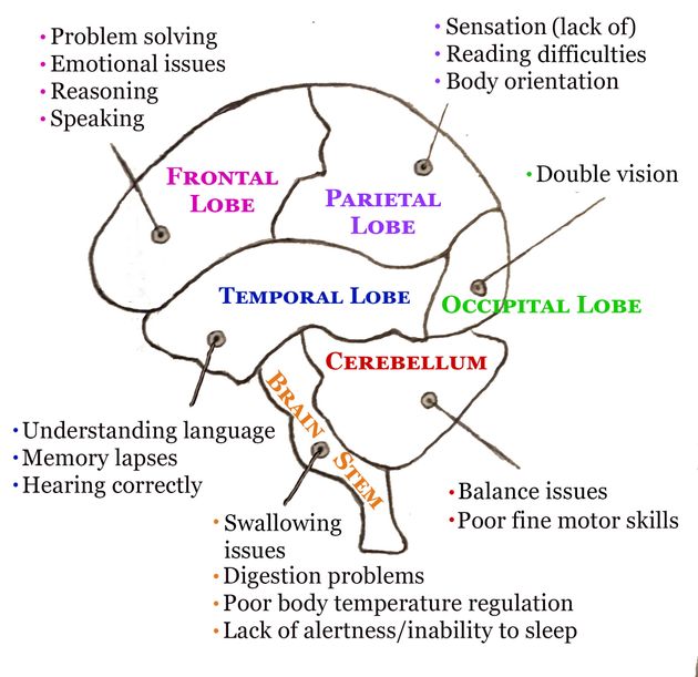 A chart the author made to explain which parts of her brain were injured by her fall, as well as how those injuries affected her brain.