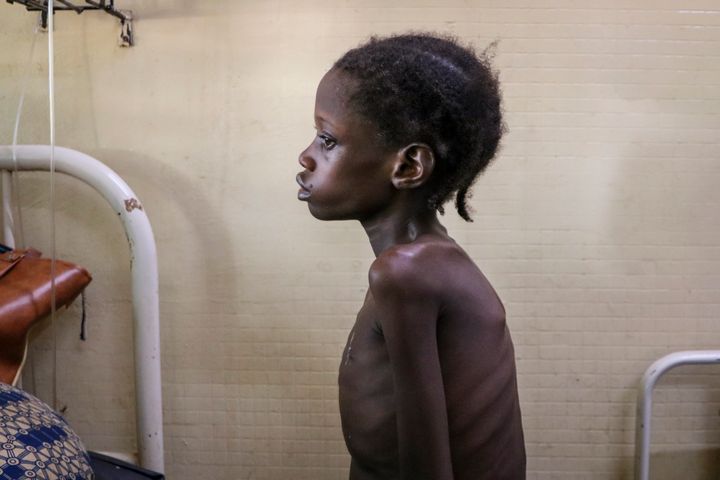 Nafissetou Niampa, 14, who struggles to breathe due to a heart condition, is treated for malnutrition at Yalgado Ouedraogo Un