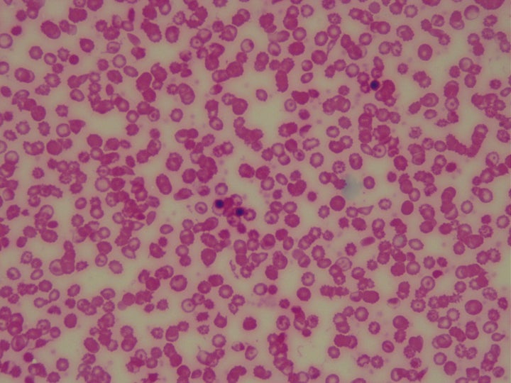 Glóbulos rojos de un paciente con anemia vistos en un microscopio. 