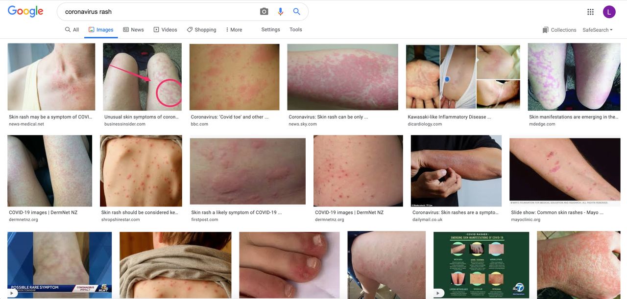 Google “Covid-19 rash” and almost every single result shows pink or red bumps and hives on caucasian skin.