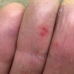 9 Photos Showing What 'Covid Fingers And Toes' Can Look