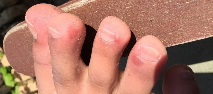 Yes, COVID-toe. A bizarre post-coronavirus symptom causes purple fingers,  toes  maybe even ears, Coronavirus