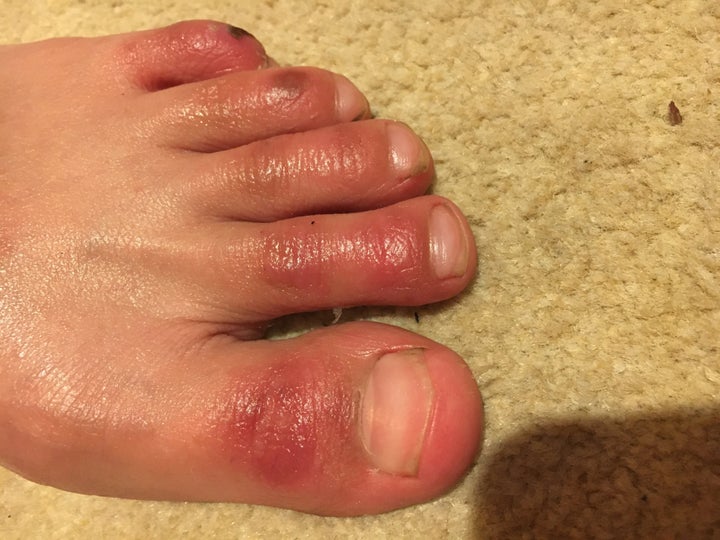 Yes, COVID-toe. A bizarre post-coronavirus symptom causes purple fingers,  toes  maybe even ears, Coronavirus