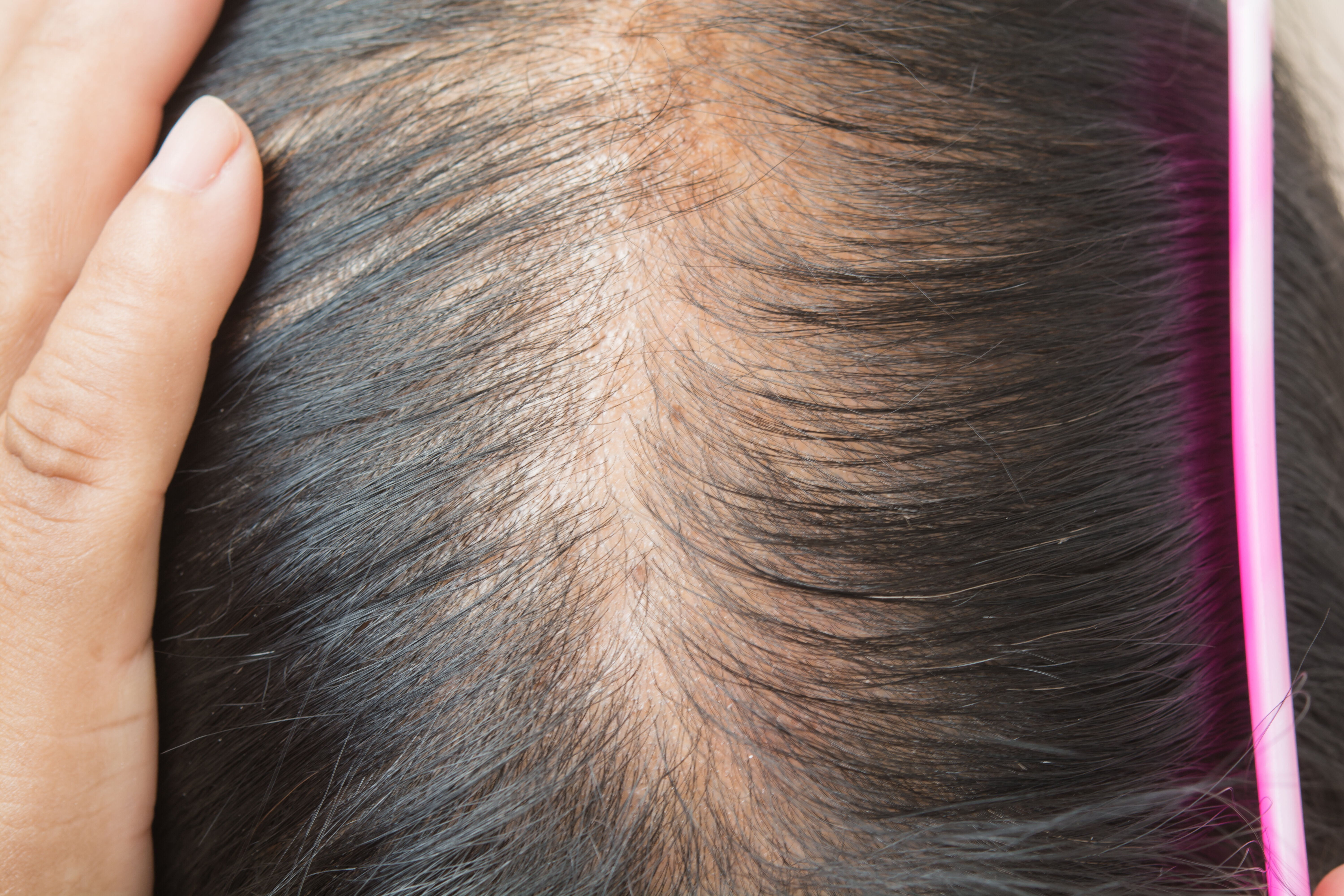 Can Covid 19 Cause Hair Loss Here S What You Need To Know HuffPost Life   5f366588220000b5ef388a92 