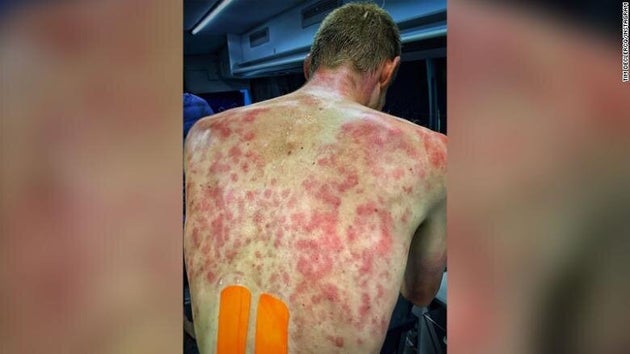 Γαλλία: Ποδηλάτες αποκόμισαν τρομακτικά σημάδια από χαλάζι σε μέγεθος