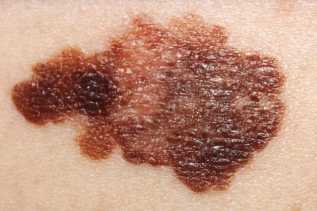 Melanoma Deaths Rise By 150% In 50 Years. How To Spot The Signs