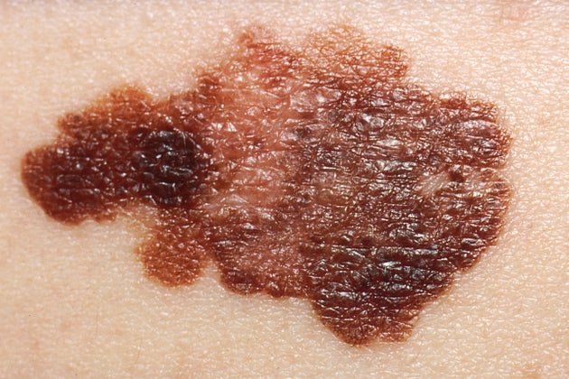 Melanoma skin cancer