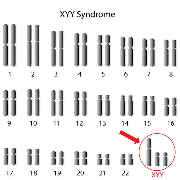 XYY 증후군 환자의 핵형. 빨간색 화살표는 XYY 염색체를 가리 킵니다.