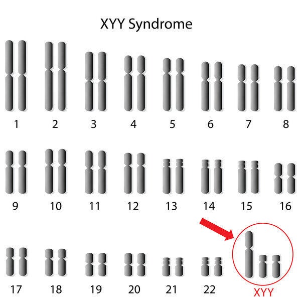 XYY 증후군 환자의 핵형.  빨간색 화살표는 XYY 염색체를 가리 킵니다.  