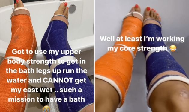 Katie Price Gets Real About The Struggles Of Having A Bath After Breaking Her Feet