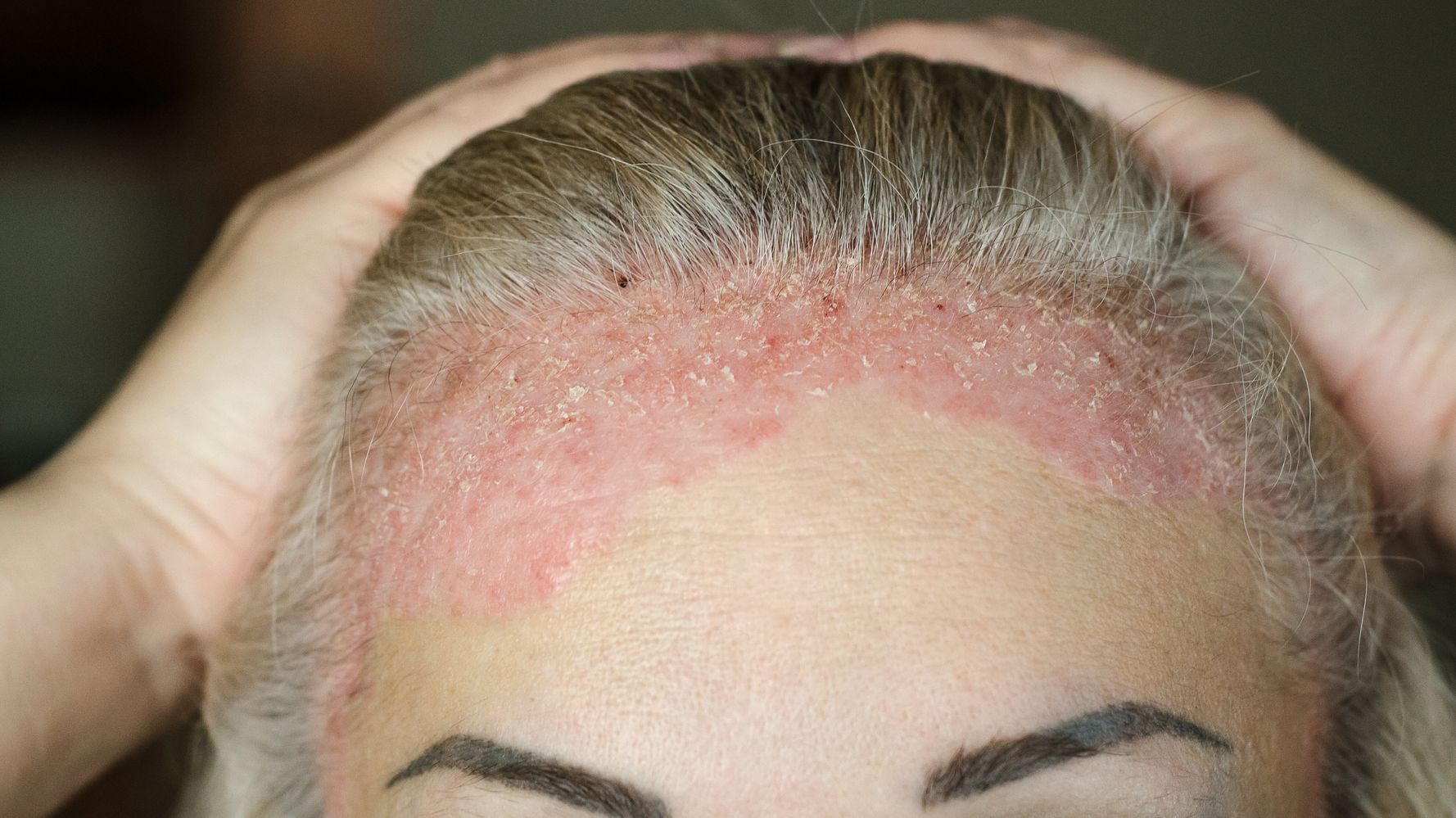 crème psoriasis cheveux hőkezelés pikkelysömörhöz