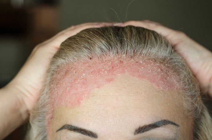 Psoriasis sévère au niveau du cuir chevelu.