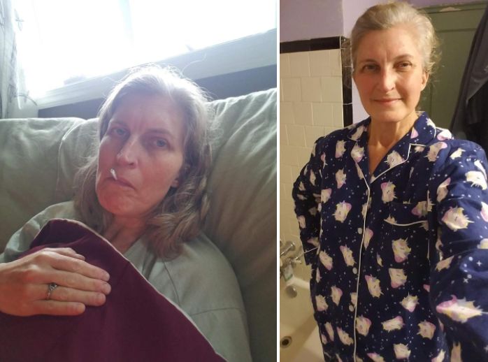 Left: Joyner during the third week of her illness. Right: During the seventh week of illness. She had lost 12 pounds by that point, she said.