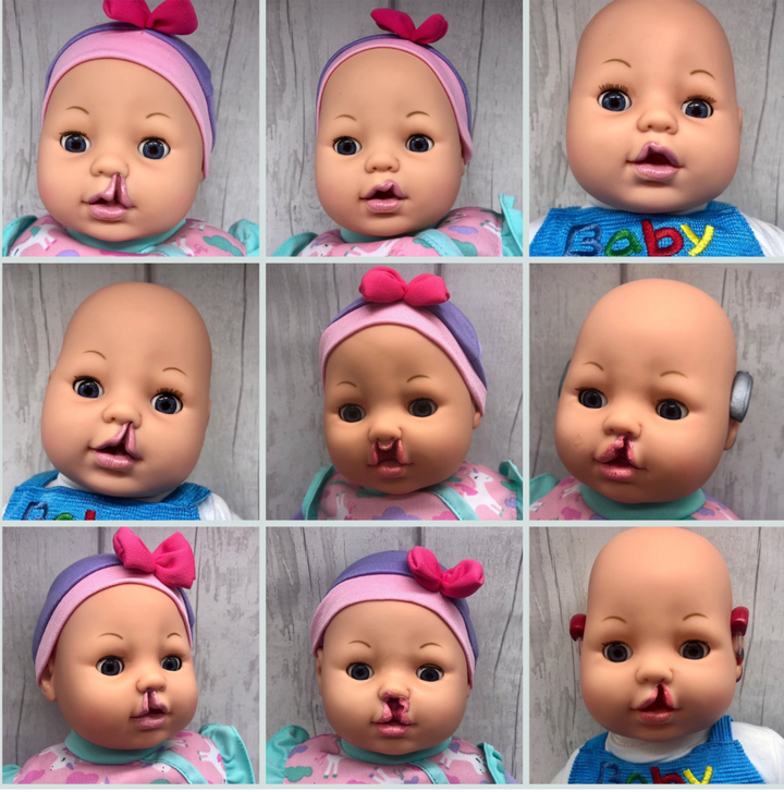 Customized cleft lip dolls from Bright Ears