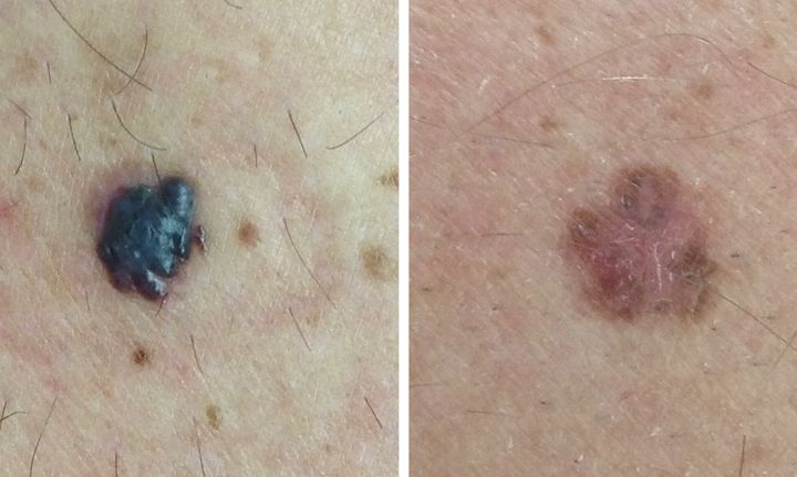 Examples of confirmed melanomas.