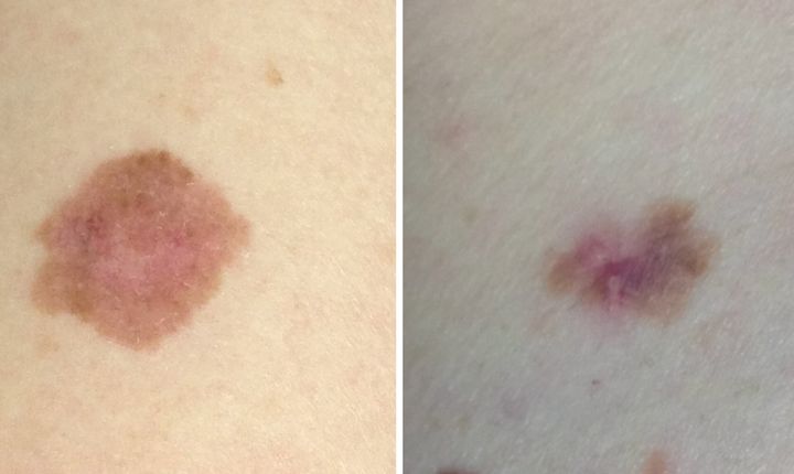 This Is What Melanoma Skin Cancer Looks Like | HuffPost UK Life