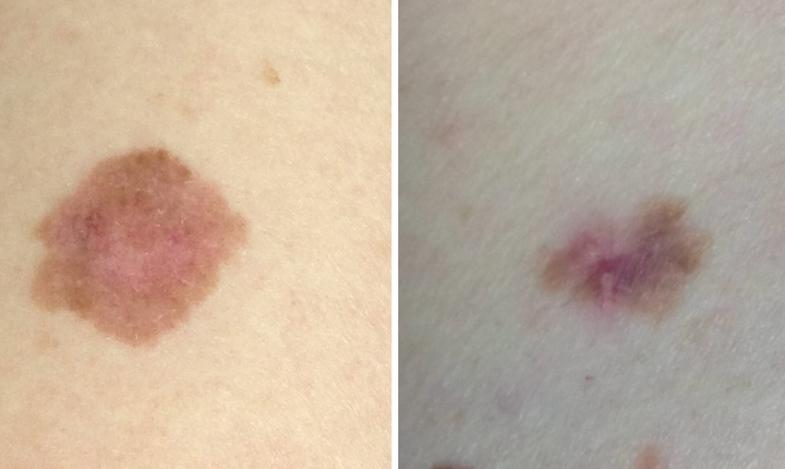 This Is What Melanoma Skin Cancer Looks Like Huffpost Uk Life 1616