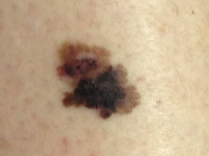 This Is What Melanoma Skin Cancer Looks Like HuffPost UK