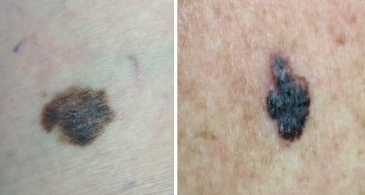 Examples of confirmed melanomas.ma