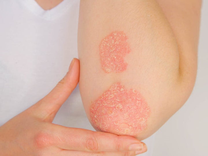 Efectos del coronavirus en la piel