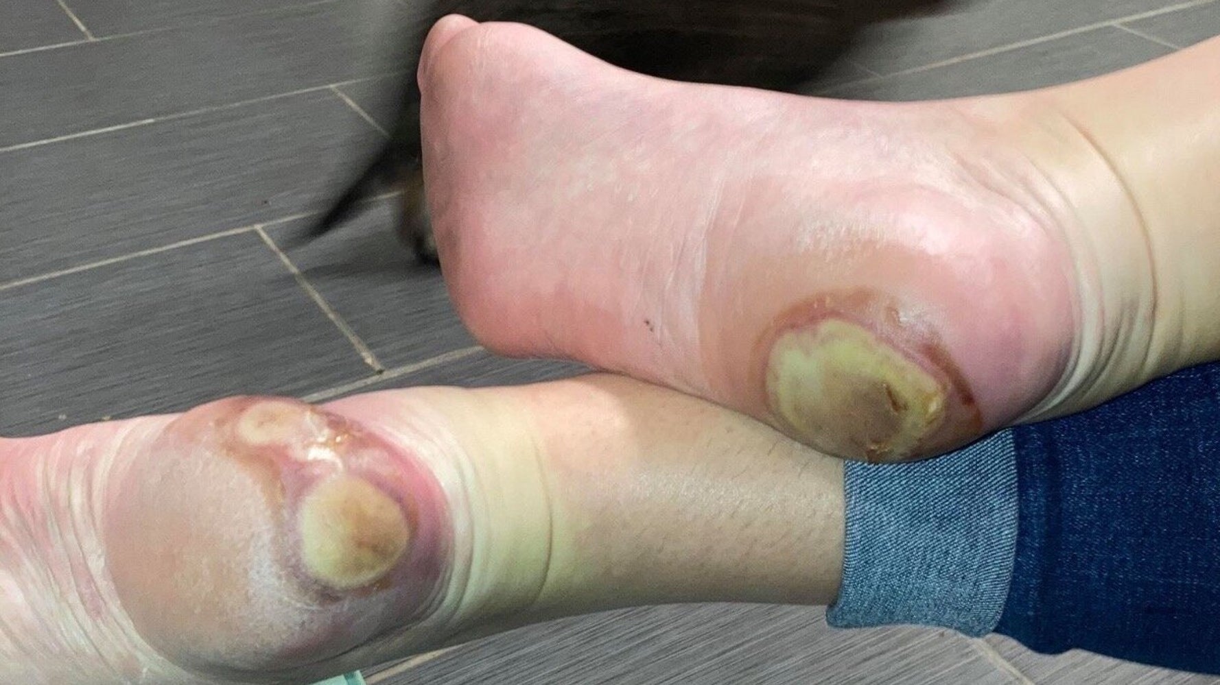 反ワクチン派 腫れた足 写真を拡散 新型コロナワクチンの副作用ではなかった ハフポスト 反ワクチン派 腫れた足 写真を拡散 新型コロナワクチンの副作用ではなかった ハフポスト