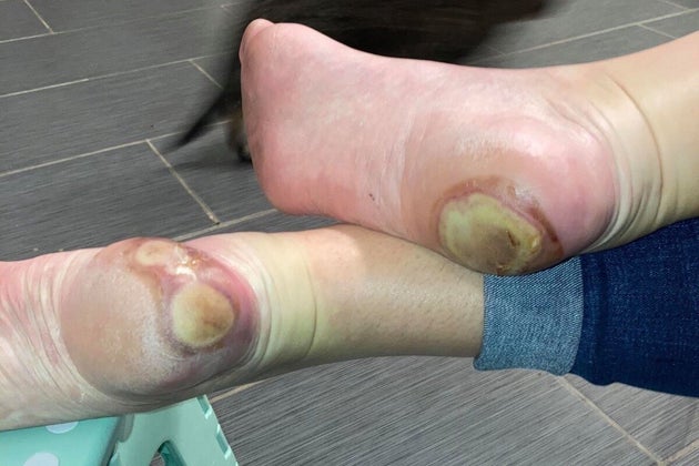 反ワクチン派 腫れた足 写真を拡散 新型コロナワクチンの副作用ではなかった ハフポスト 反ワクチン派 腫れた足 写真を拡散 新型コロナワクチンの副作用ではなかった ハフポスト