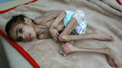 Υεμένη: Συγκλονίζει η εικόνα υποσιτισμένου 7χρονου που ζυγίζει μόλις 7