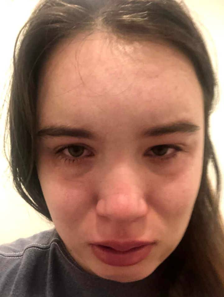 My swollen face the day after the attack.