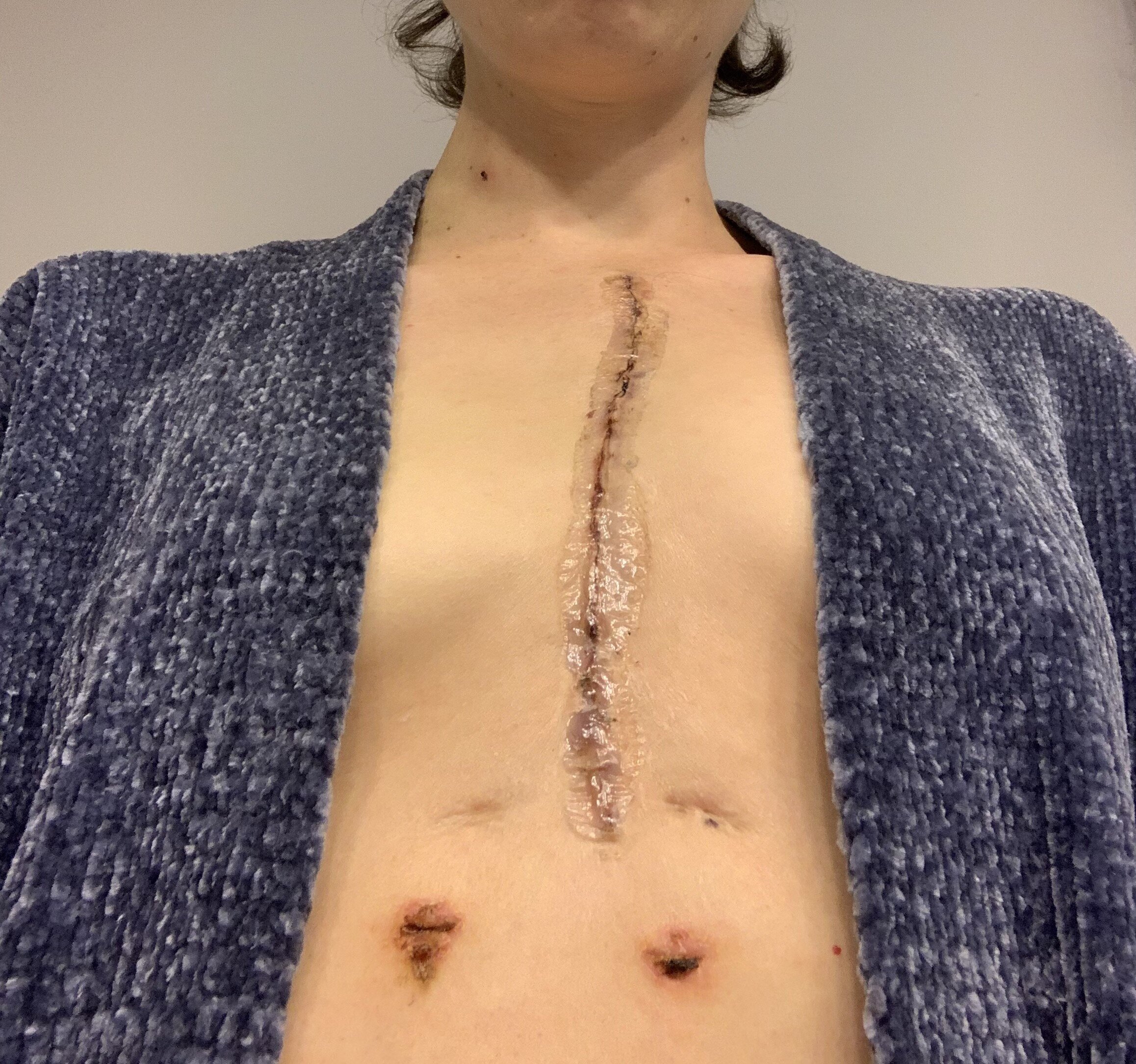 The Right Axillary Incision: A Potential New Standard of Care for Selected  Congenital Heart Surgery