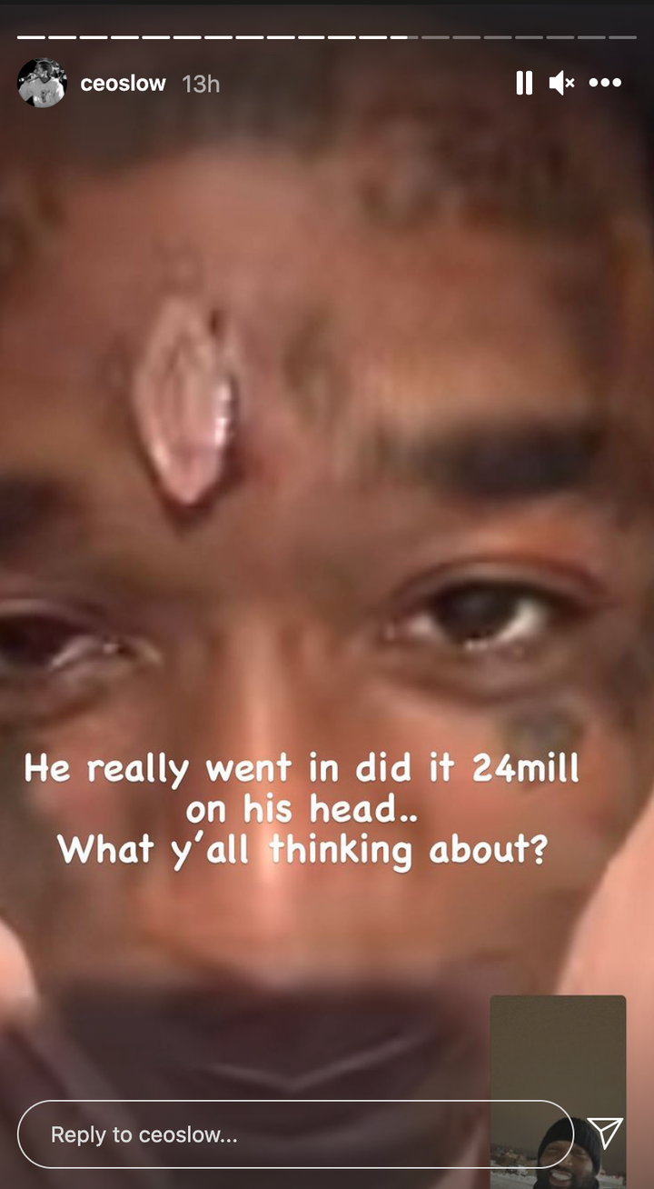 Lil Uzi Vert Apparently Got A Nearly 11 Carat Diamond Pierced Into His Forehead