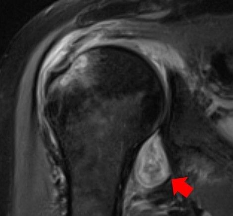 MRI image of a patient's shoulder. The red arrow points to inflammation in the joint. The Covid virus triggered rheumatoid arthritis in this patient with prolonged shoulder pain after other covid symptoms resolved.